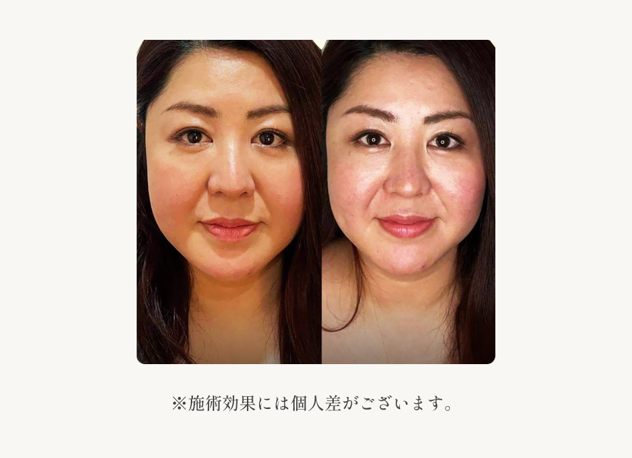 facial_after
